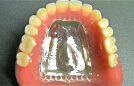 コバルトクロム床義歯（片顎） 