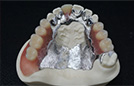 コバルト床義歯 